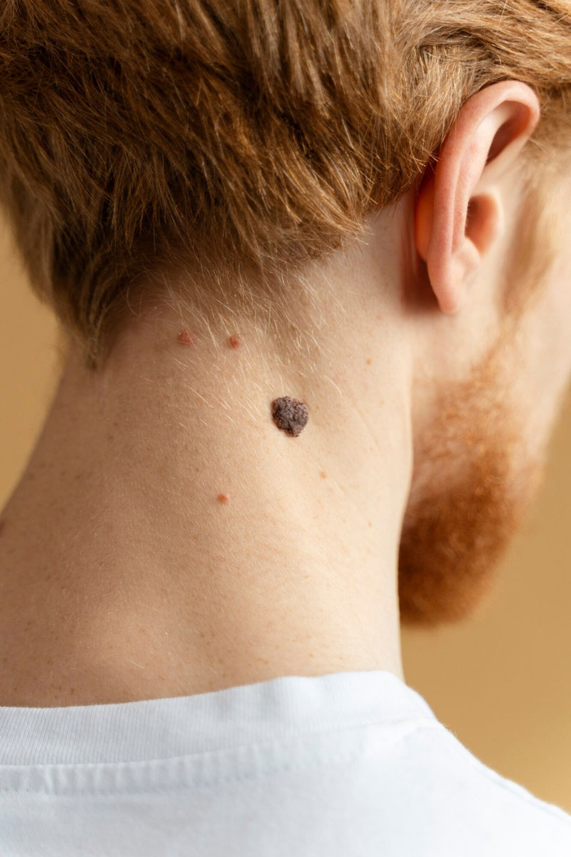 Skin Lesion Management Skin Lesion Management